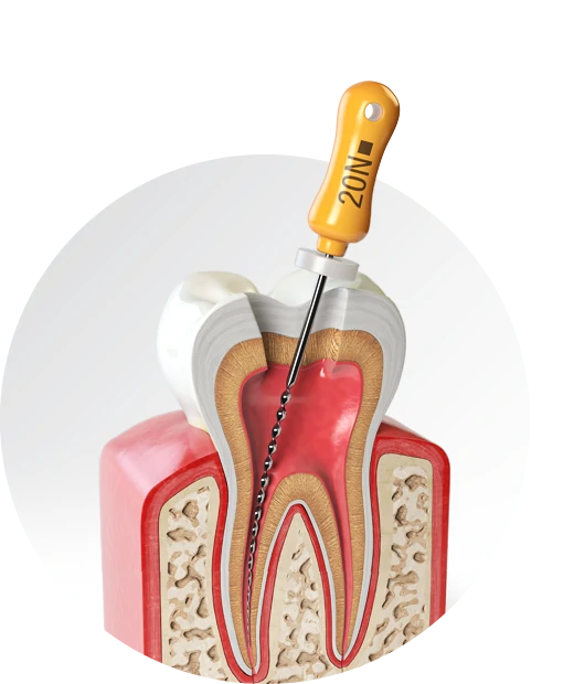 Leczenie kanałowe zębów - endodoncja